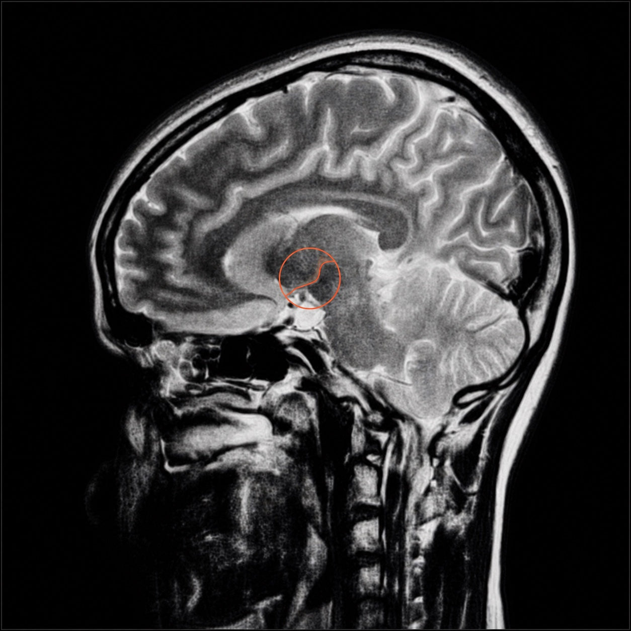 Sagittal brain scan with a radiant persimmon marker